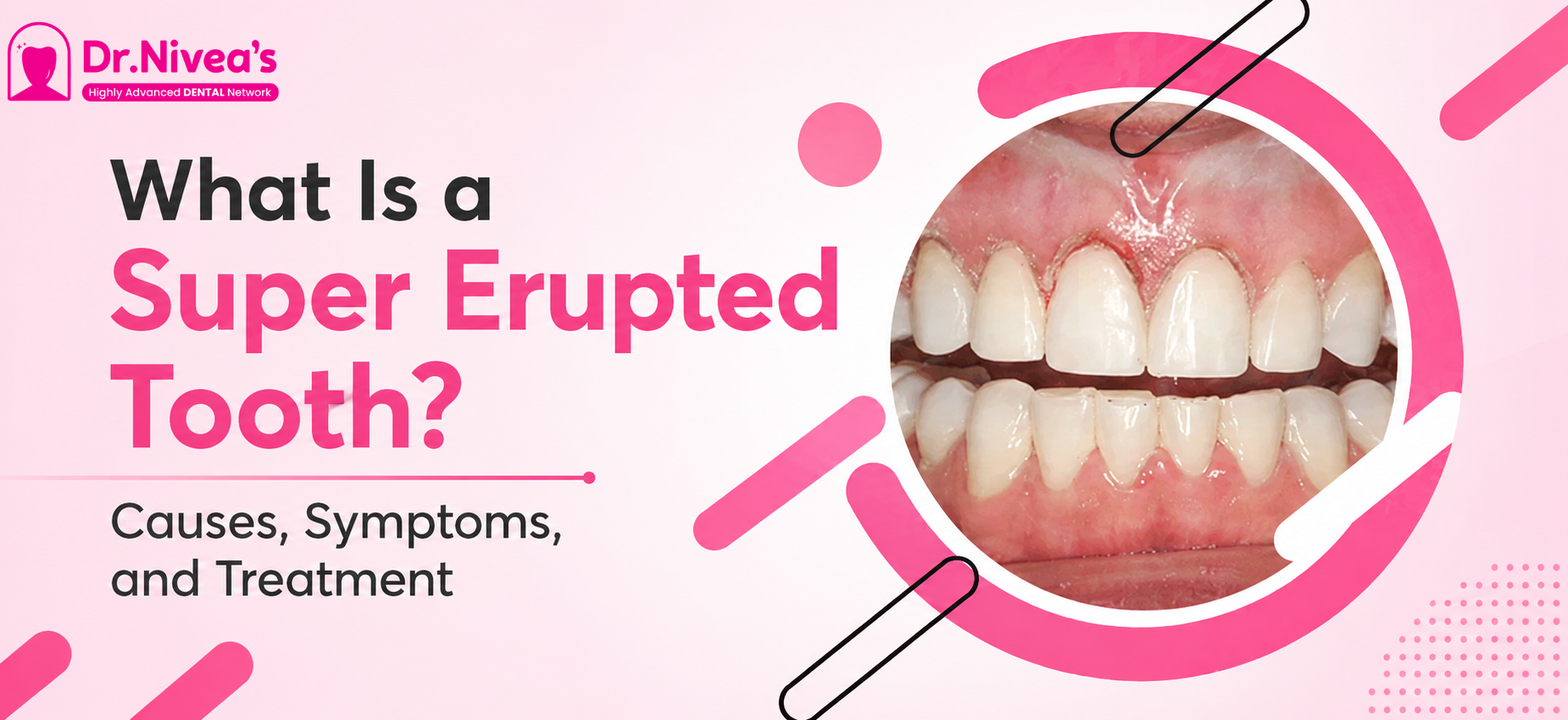 implants-vs-bridges-your-ultimate-tooth-restoration-comparison